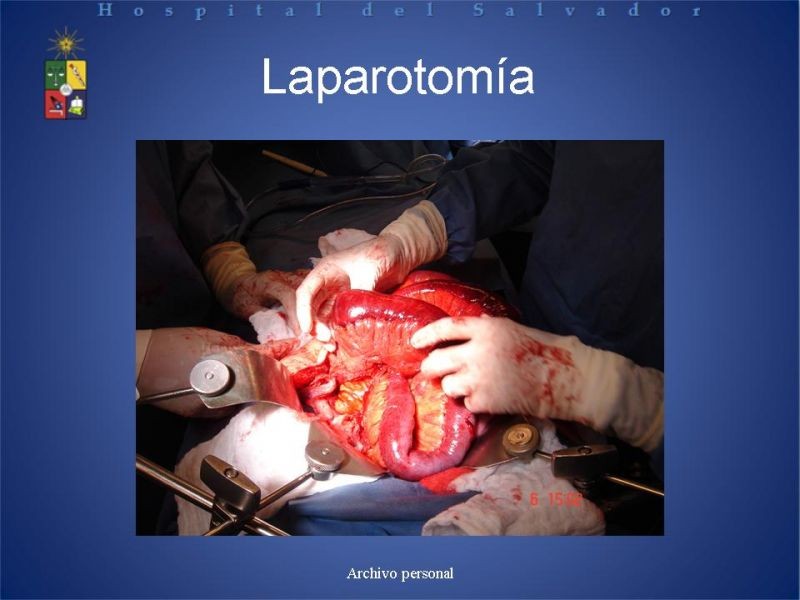 Diapositiva 14 de Trombosis Venosa Mesentérica