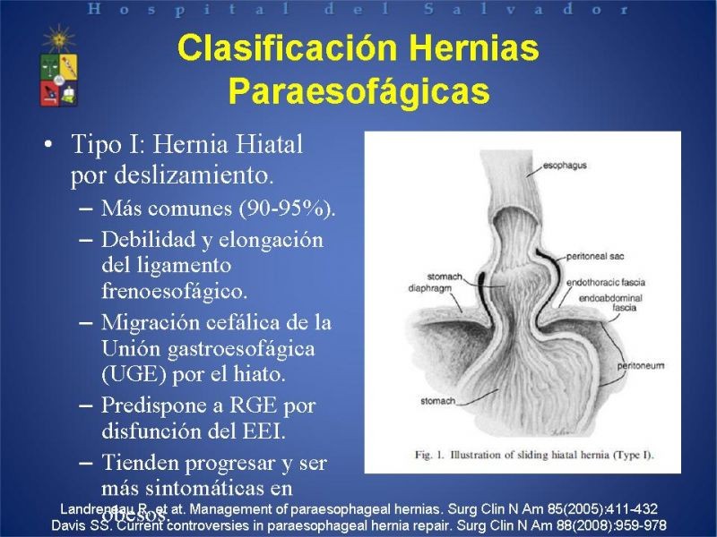 Diapositiva 9 de Hernia Hiatal