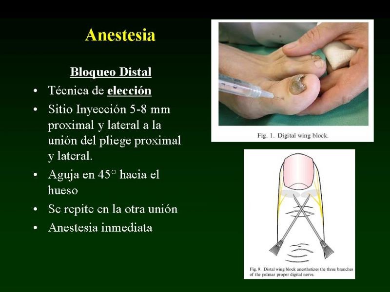 Diapositiva 5 de Técnica de la Onicectomía