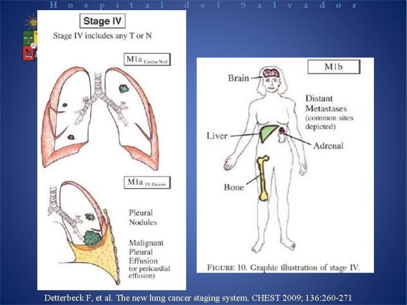 Diapositiva 23 de Cáncer Pulmonar
