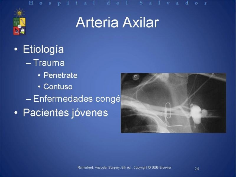 Diapositiva 23 de Aneurismas periféricos