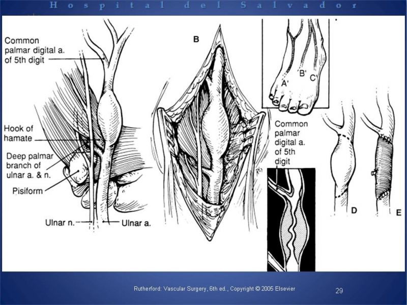 Diapositiva 28 de Aneurismas periféricos