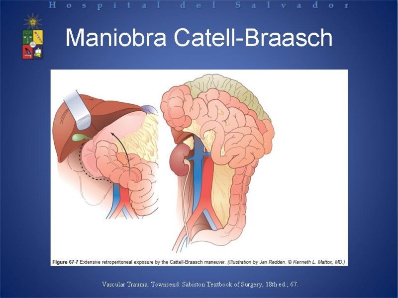 Diapositiva 20 de Trauma Abdominal: Damage Control.