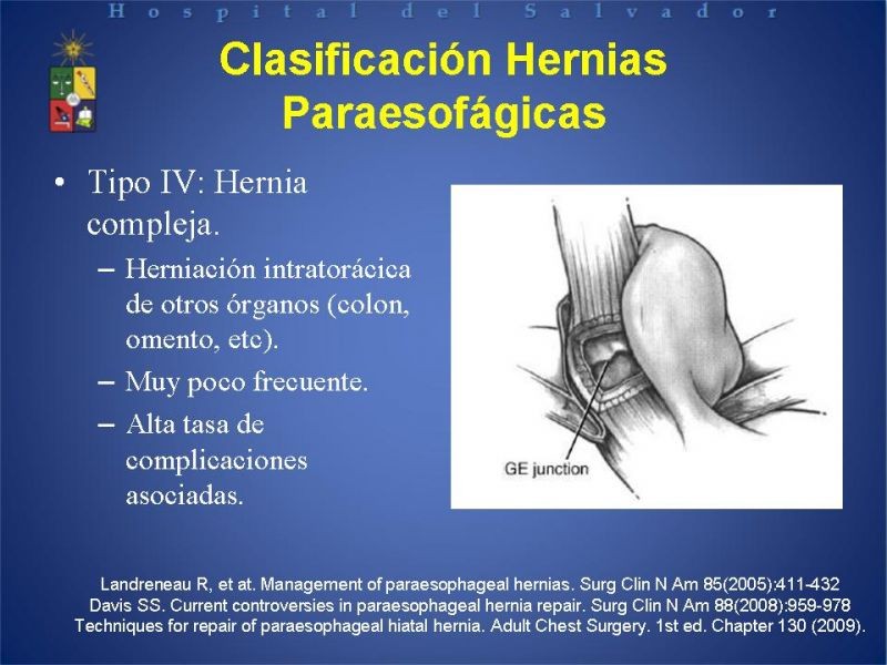 Diapositiva 12 de Hernia Hiatal