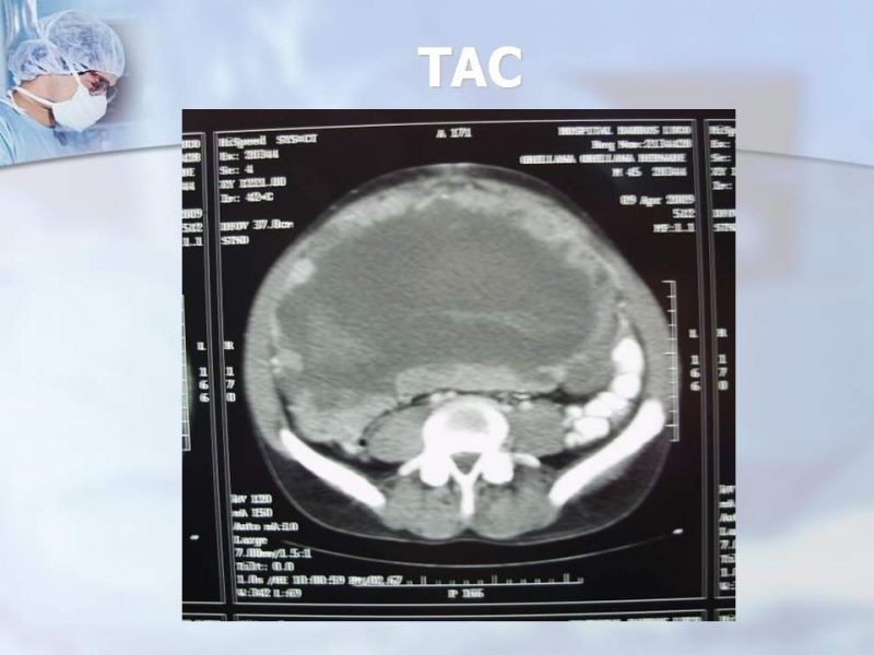 Diapositiva 28 de Sarcomas Retroperitoneales