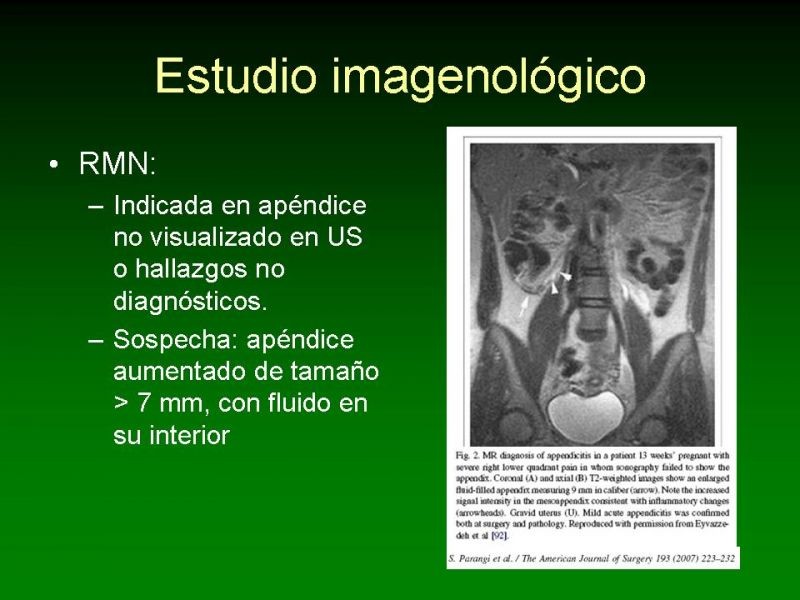 Diapositiva 13 de Apendicitis Aguda y Embarazo