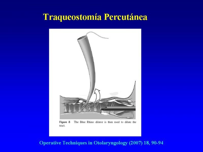 Diapositiva 28 de Traqueostomía