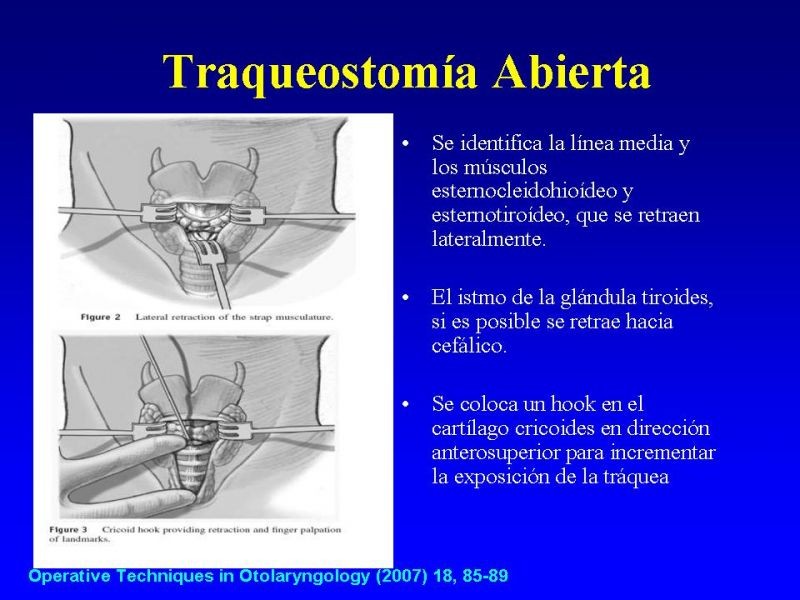 Diapositiva 13 de Traqueostomía