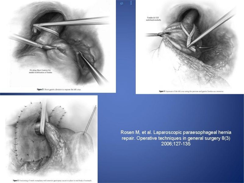 Diapositiva 27 de Hernia Hiatal