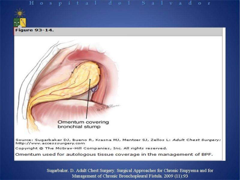 Diapositiva 25 de Empiema Pleural: Paraneumónico, posquirúrgico y post resección pulmonar. Tratamiento quirúrgico.
