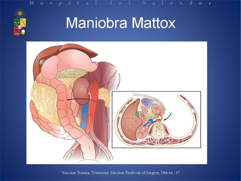 Diapositiva 18 de Trauma Abdominal: Damage Control.