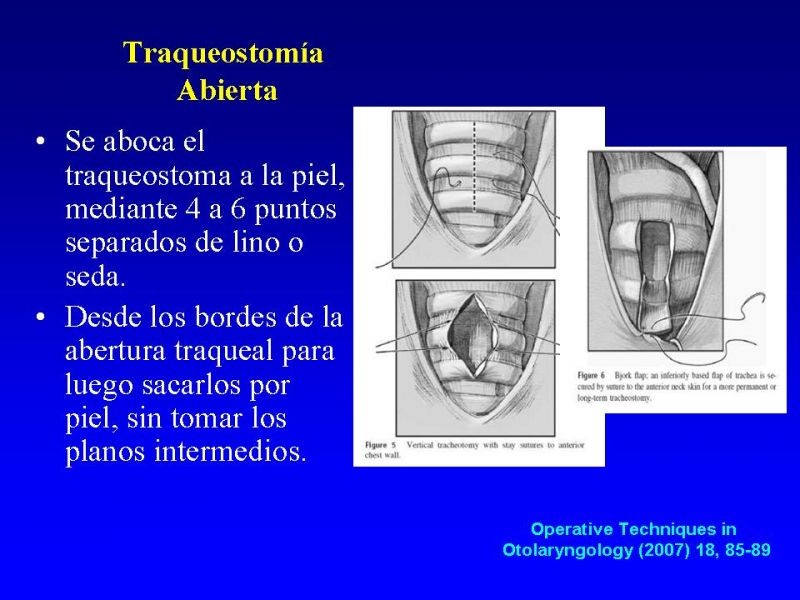 Diapositiva 15 de Traqueostomía