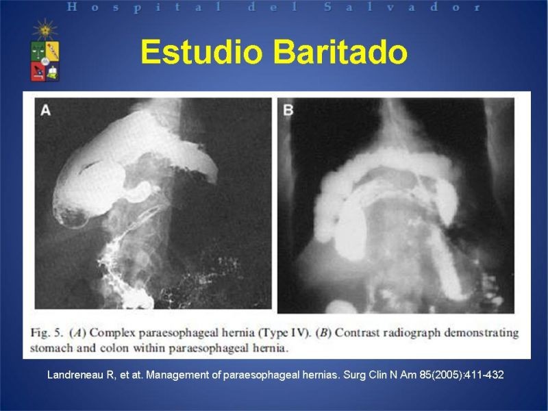 Diapositiva 17 de Hernia Hiatal