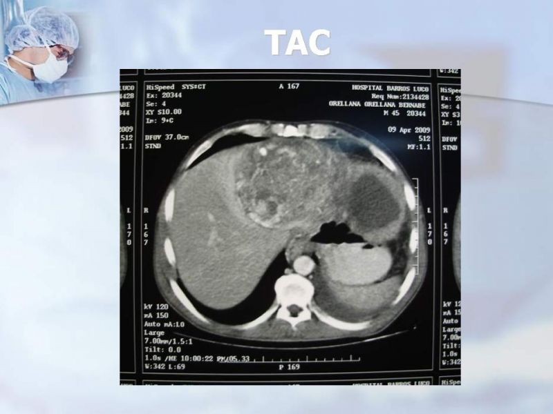 Diapositiva 27 de Sarcomas Retroperitoneales