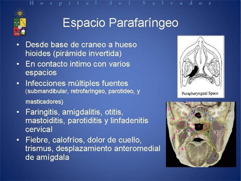 Diapositiva 16 de Abscesos Cervicales Profundos