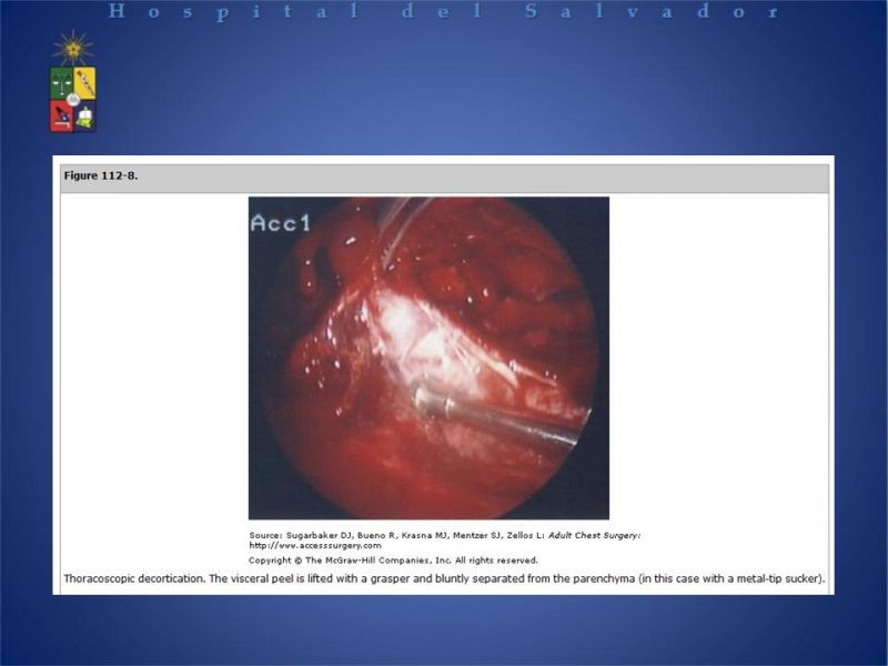 Diapositiva 15 de Empiema Pleural: Paraneumónico, posquirúrgico y post resección pulmonar. Tratamiento quirúrgico.