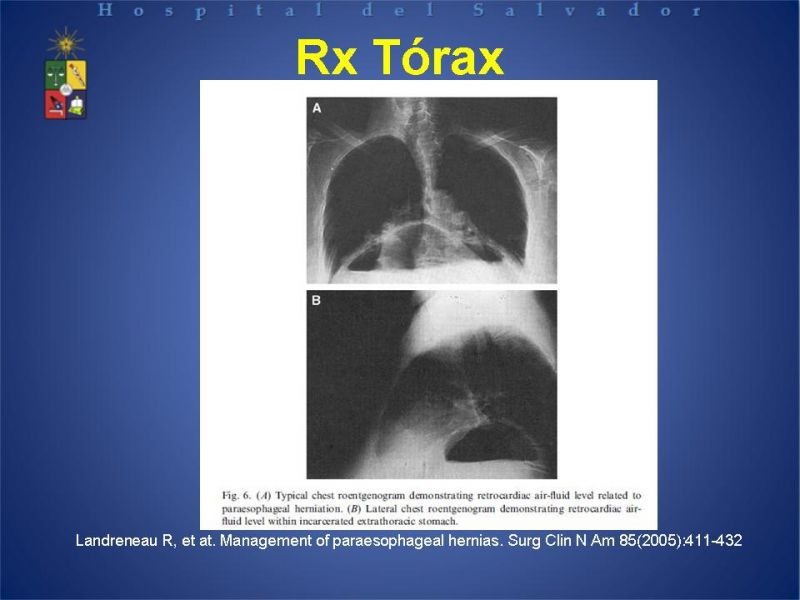 Diapositiva 15 de Hernia Hiatal