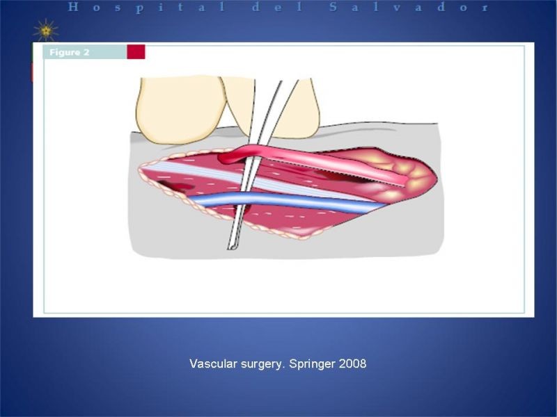 Diapositiva 14 de Reunión de Técnica Quirúrgica: Accesos Vasculares para Hemodiálisis