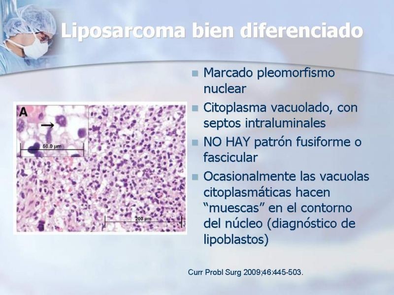 Diapositiva 12 de Sarcomas Retroperitoneales