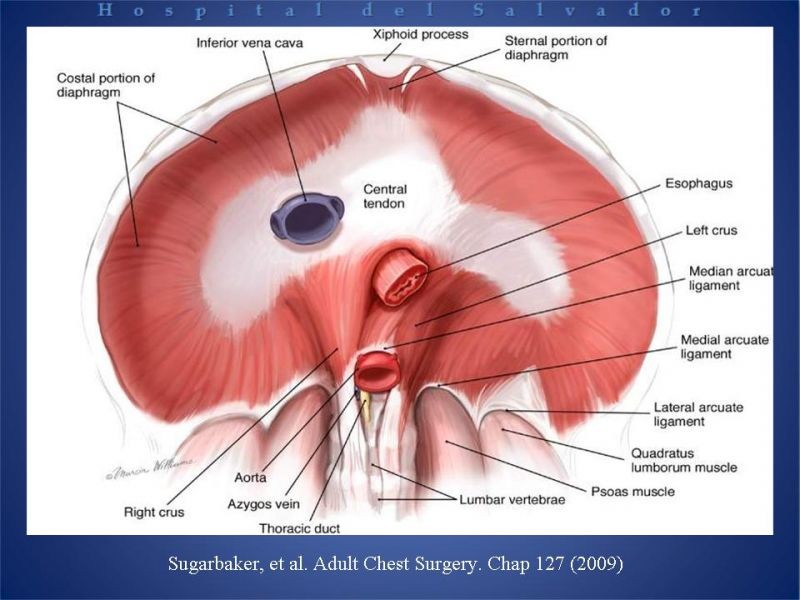 Diapositiva 7 de Hernia Hiatal