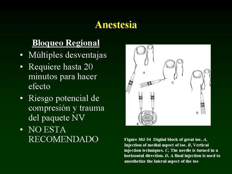 Diapositiva 4 de Técnica de la Onicectomía