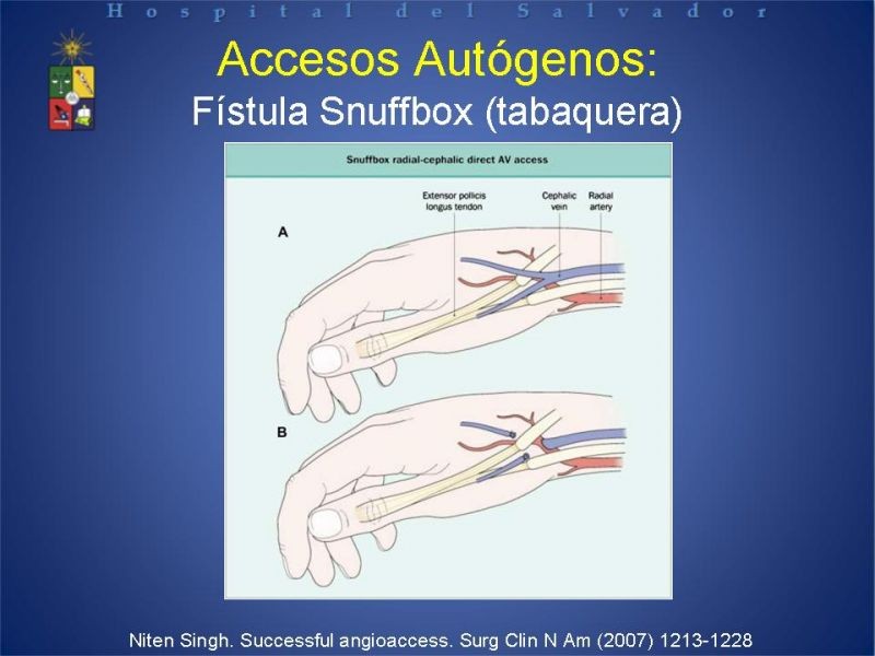 Diapositiva 18 de Reunión de Técnica Quirúrgica: Accesos Vasculares para Hemodiálisis