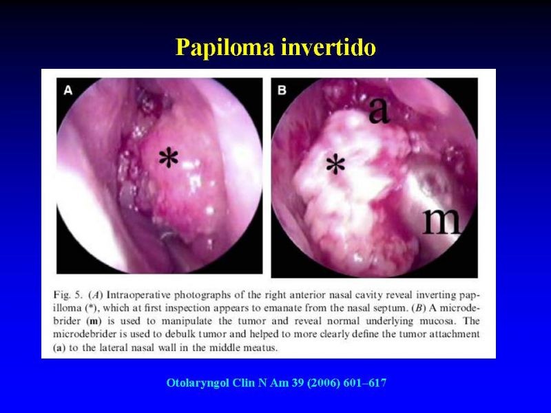 Diapositiva 12 de Tumores de Senos Paranasales