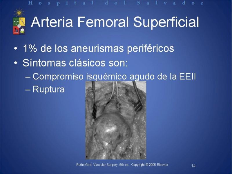 Diapositiva 13 de Aneurismas periféricos