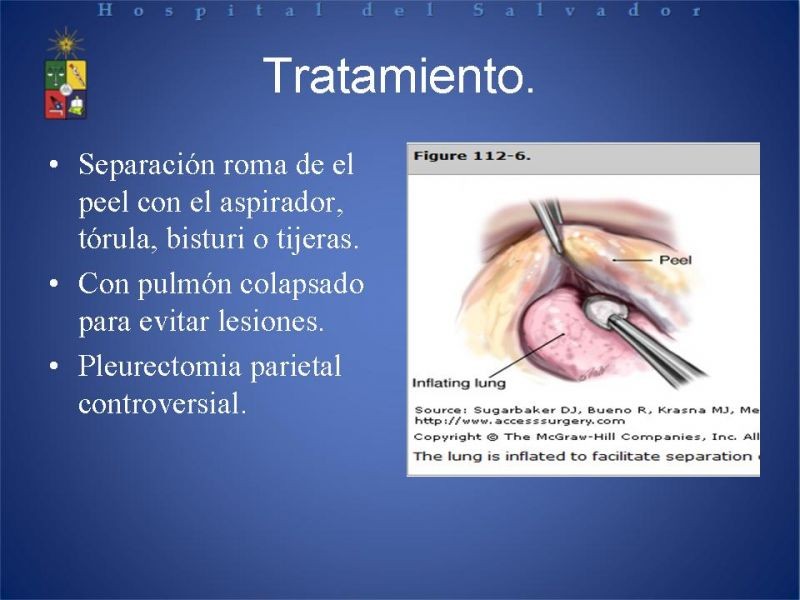 Diapositiva 20 de Empiema Pleural: Paraneumónico, posquirúrgico y post resección pulmonar. Tratamiento quirúrgico.