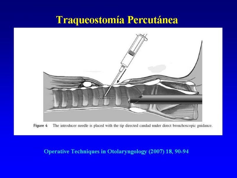 Diapositiva 24 de Traqueostomía