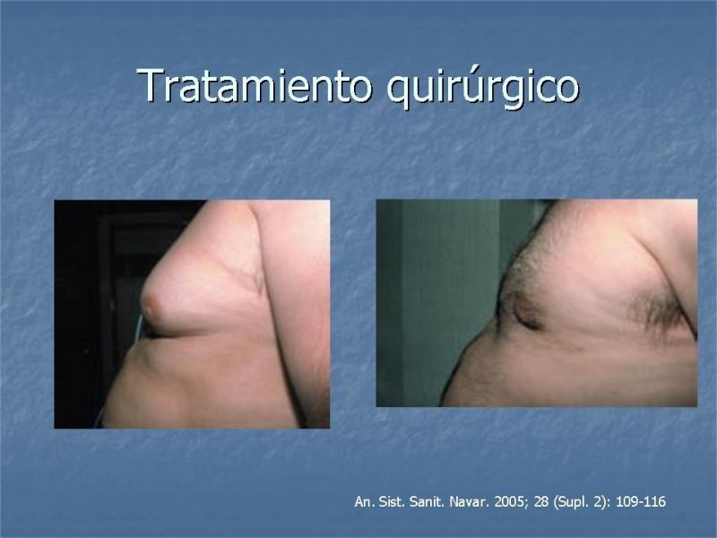 Diapositiva 23 de Ginecomastia