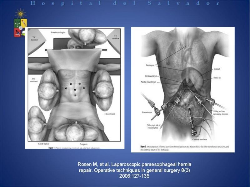 Diapositiva 26 de Hernia Hiatal