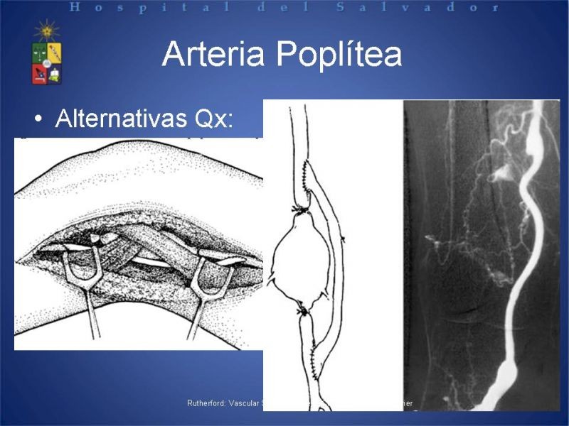 Diapositiva 17 de Aneurismas periféricos