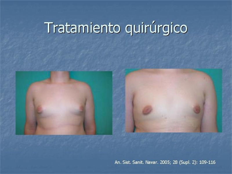 Diapositiva 21 de Ginecomastia