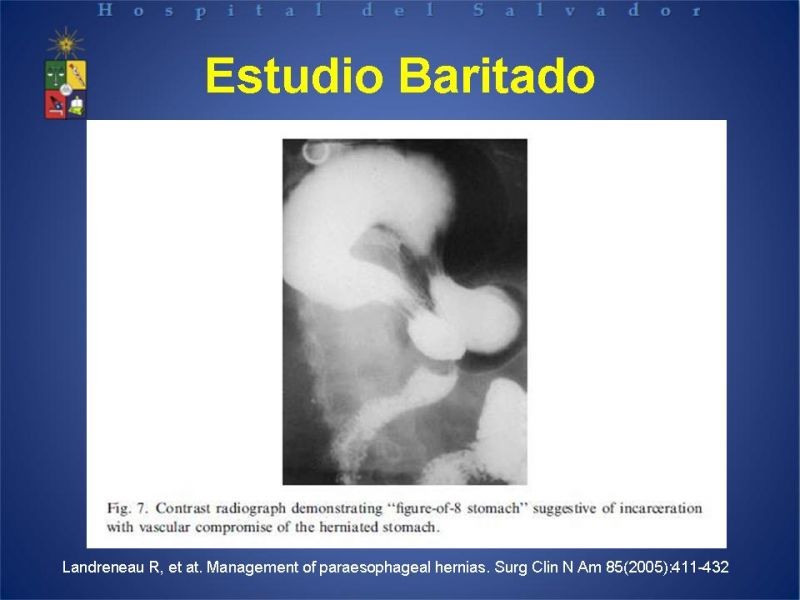 Diapositiva 18 de Hernia Hiatal