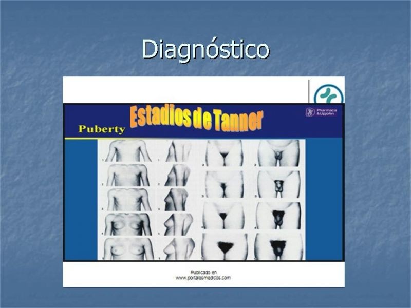 Diapositiva 9 de Ginecomastia