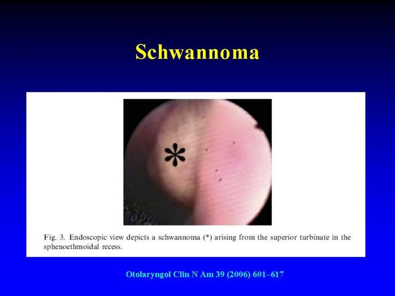 Diapositiva 9 de Tumores de Senos Paranasales