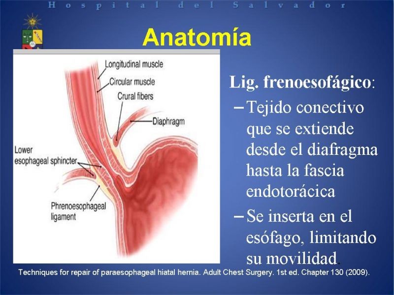 Diapositiva 8 de Hernia Hiatal