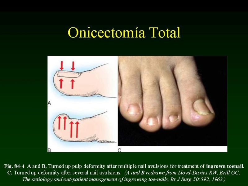 Diapositiva 9 de Técnica de la Onicectomía