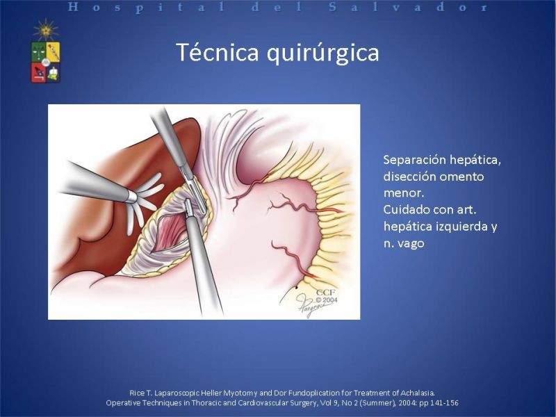 Diapositiva 16 de Manejo laparoscópico de la Acalasia