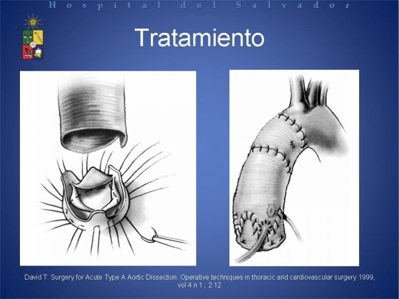 Diapositiva 26 de Disección Aortica tipo A