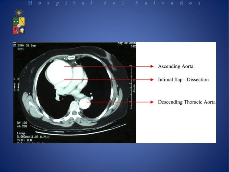 Diapositiva 14 de Disección Aortica tipo A