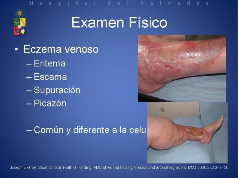 Diapositiva 7 de Úlceras de EEII