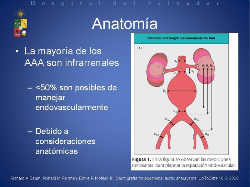 Diapositiva 7 de Manejo Endovascular del AAA (EVAR)