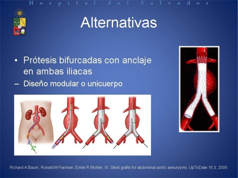 Diapositiva 6 de Manejo Endovascular del AAA (EVAR)