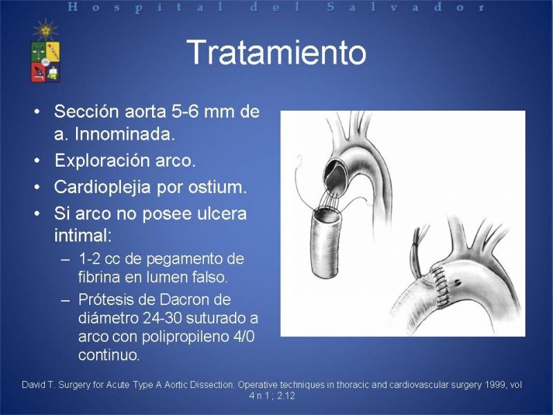 Diapositiva 23 de Disección Aortica tipo A