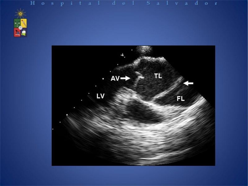 Diapositiva 16 de Disección Aortica tipo A