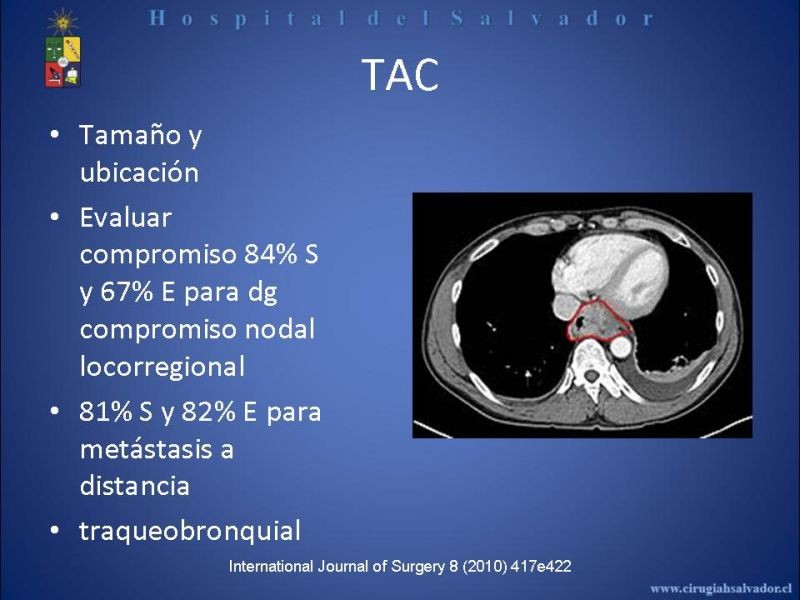 Diapositiva 23 de Cáncer de Esófago: Diagnóstico y etapificación