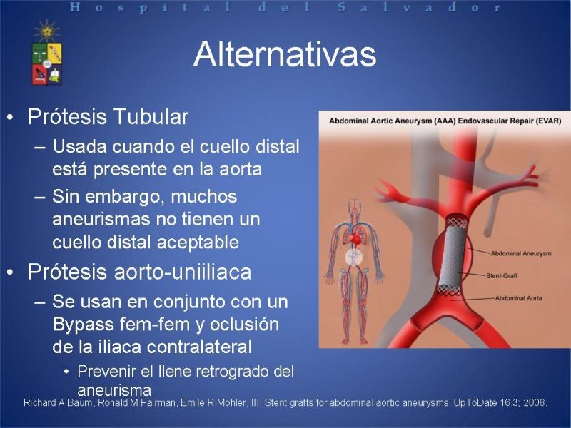 Diapositiva 5 de Manejo Endovascular del AAA (EVAR)