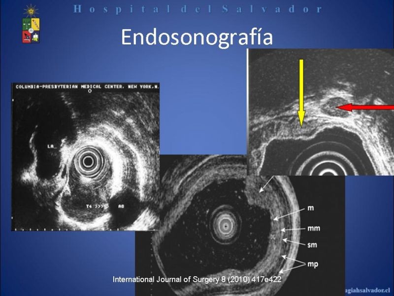 Diapositiva 26 de Cáncer de Esófago: Diagnóstico y etapificación